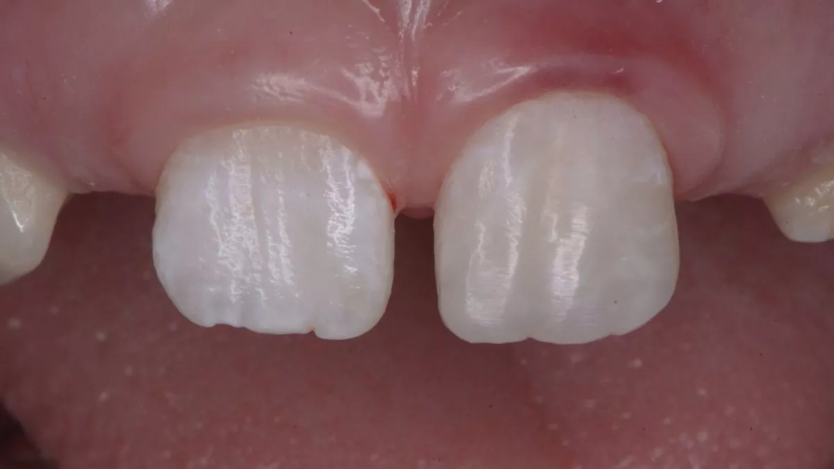 Стоматология Москва лучшие клиники. Прямая реставрация с использованием композитного материала в одно посещение