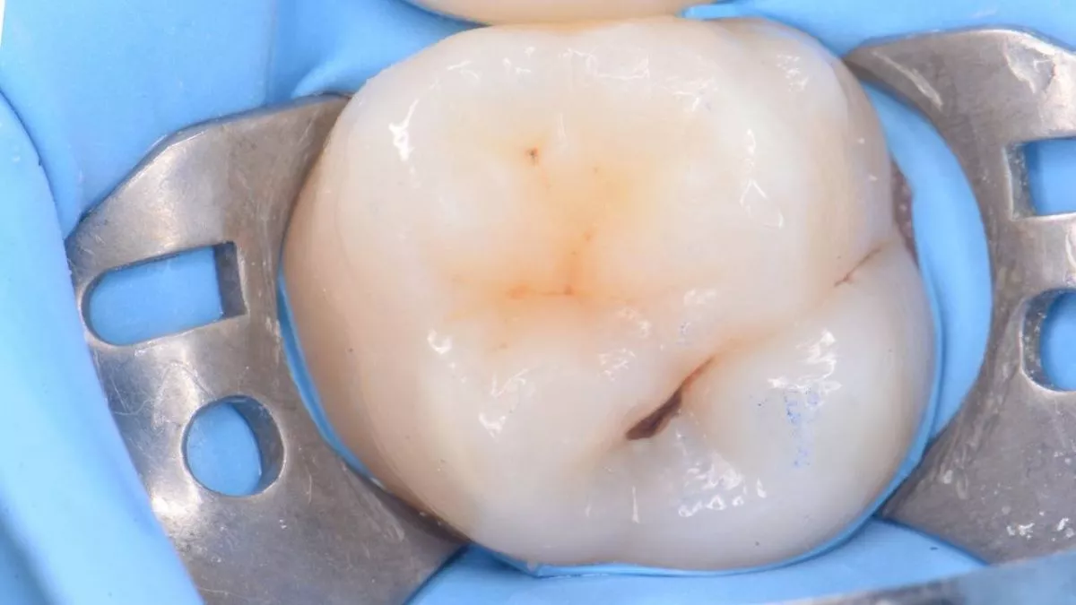 Стоматология Москва лучшие клиники. Лечение кариеса. Композитная реставрация с восстановлением функциональных ориентиров - до процедуры