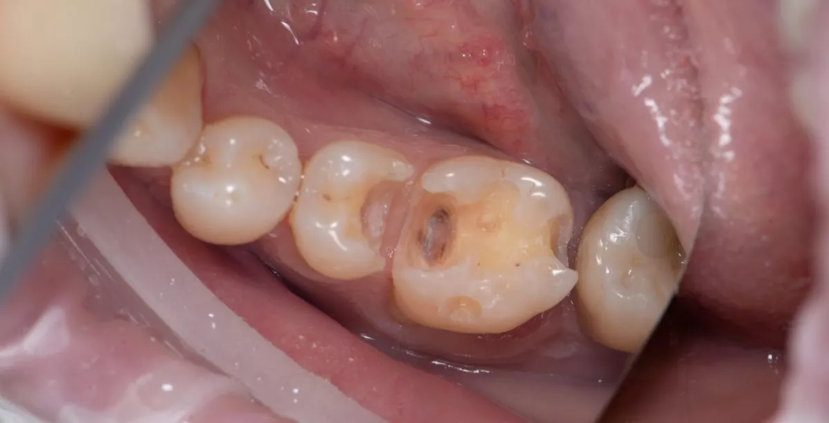 Лучшие стоматологические клиники. Лечение скрытого кариеса под старой пломбой  - до процедуры