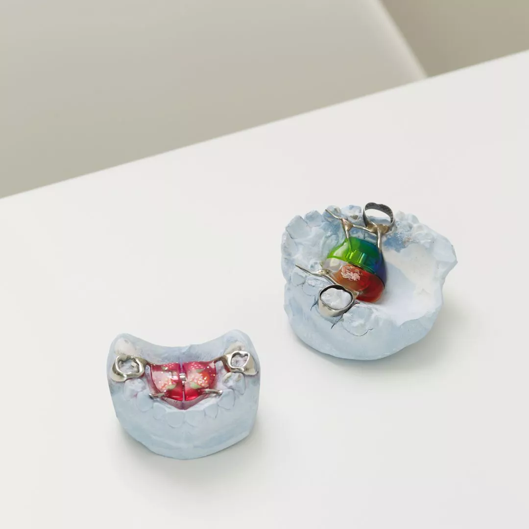 Лечение на ортодонтических пластинках