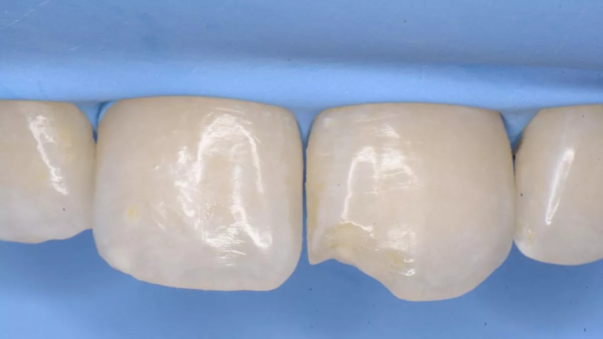 Стоматология Москва лучшие клиники. Художественная реставрация переднего зуба с использованием композита. Восстановление оптики зуба - до процедуры