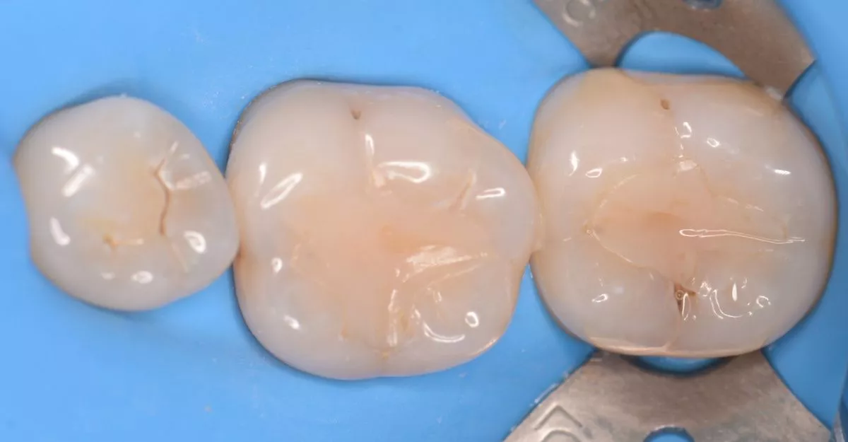 Где лучшая стоматология? Современное лечение кариеса под увеличением - до процедуры