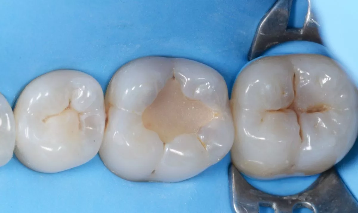 Где лучшая стоматология? Фиссурный кариес: лечение и восстановление естественных фиссур - до процедуры