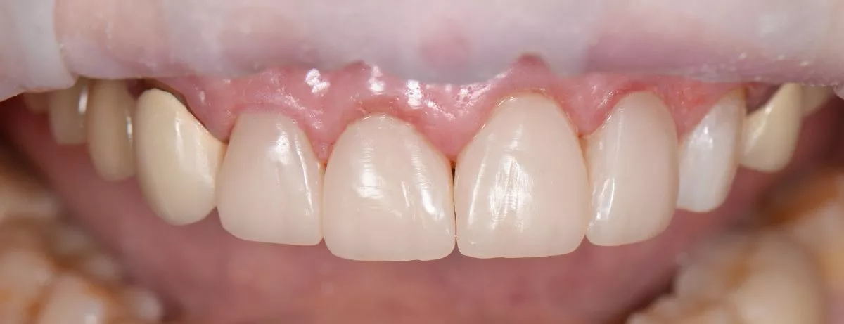 Лучшие стоматологические клиники. Композитная реставрация 4 верхних зубов в зоне улыбки