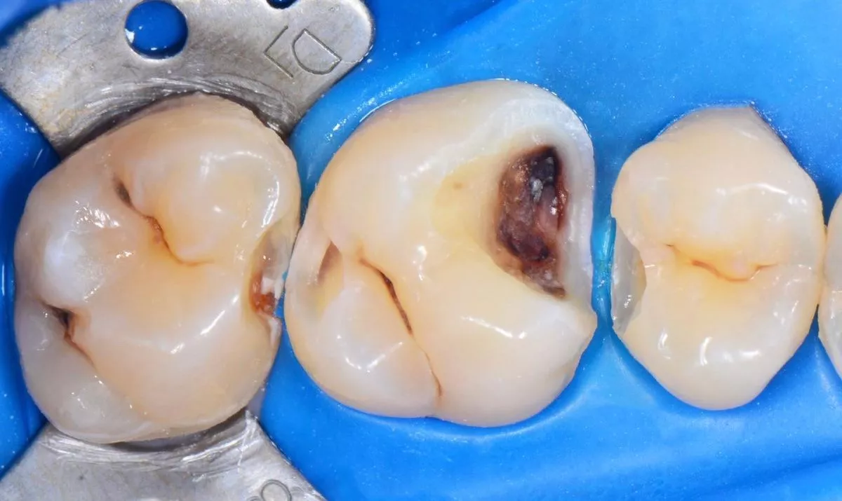 Где лучшая стоматология? Лечение межзубного кариеса 3-х зубов - до процедуры