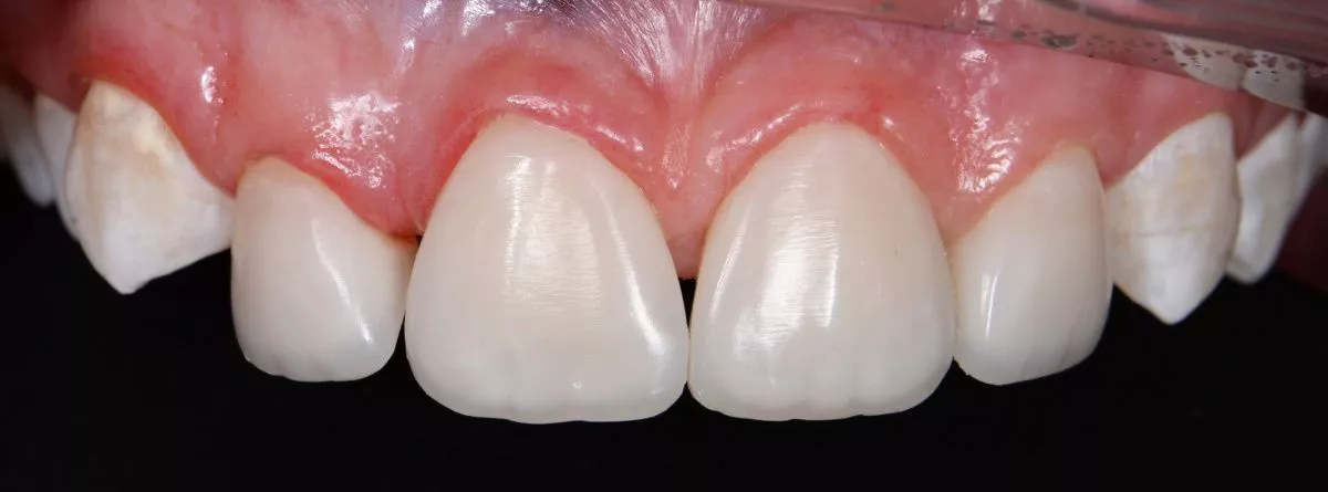 Лучшие стоматологические клиники. Эстетические реставрации в зоне улыбки