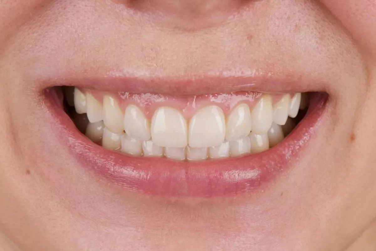 Фото после процедуры