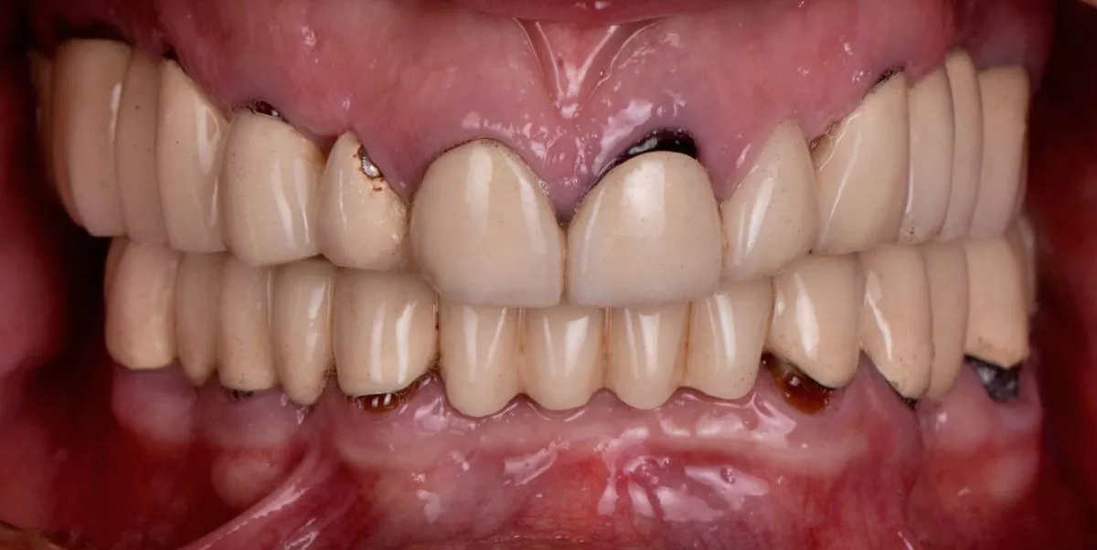 Премиум стоматологии Москва. Тотальная реабилитация - имплантация all-in-6 и замена керамических виниров и коронок - до процедуры