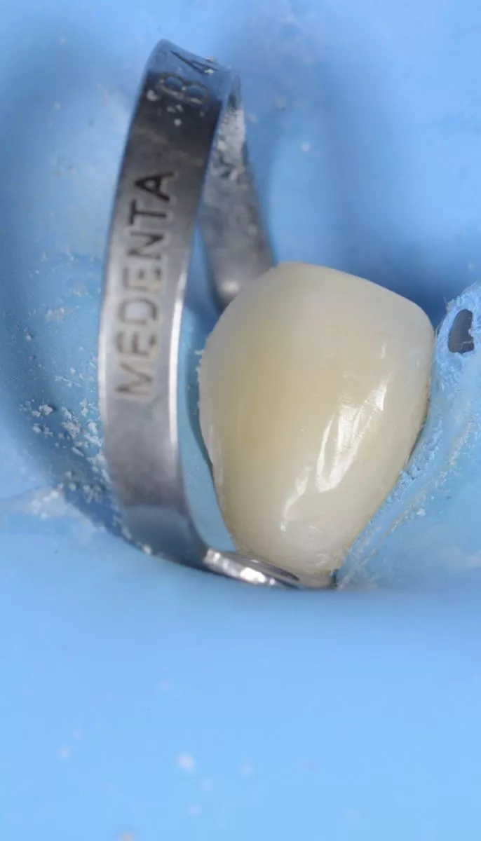 Стоматология Москва лучшие клиники. Лечение пришеечного глубокого кариеса с использованием микроскопа