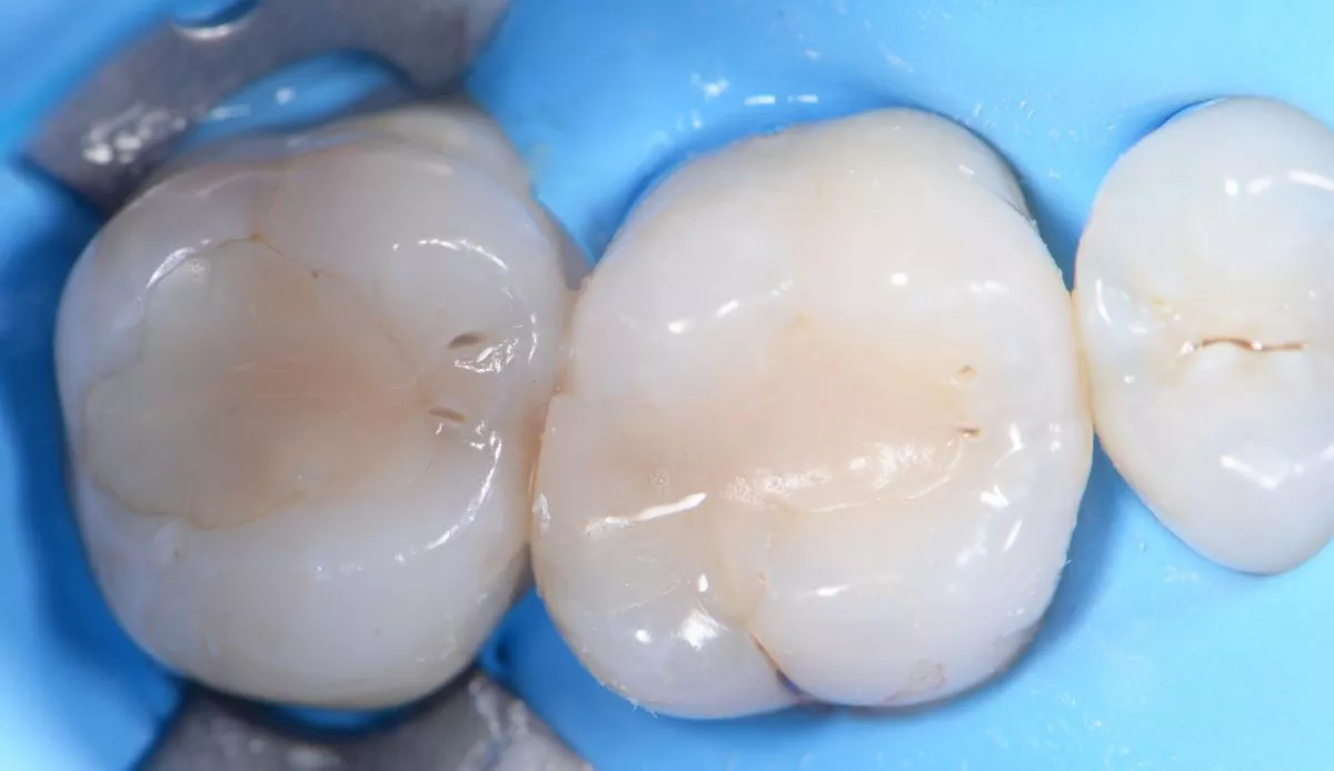 Где лучшая стоматология? Лечение кариеса с восстановлением анатомии зуба - до процедуры