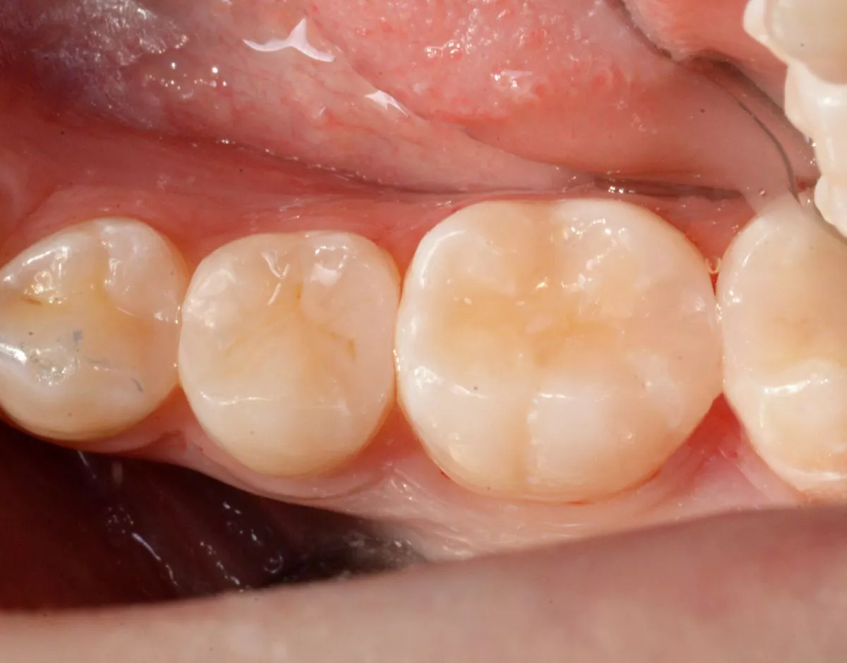 Стоматологии премиум класса в Москве. Поверхностный кариес фиссур – терапия без осложнений