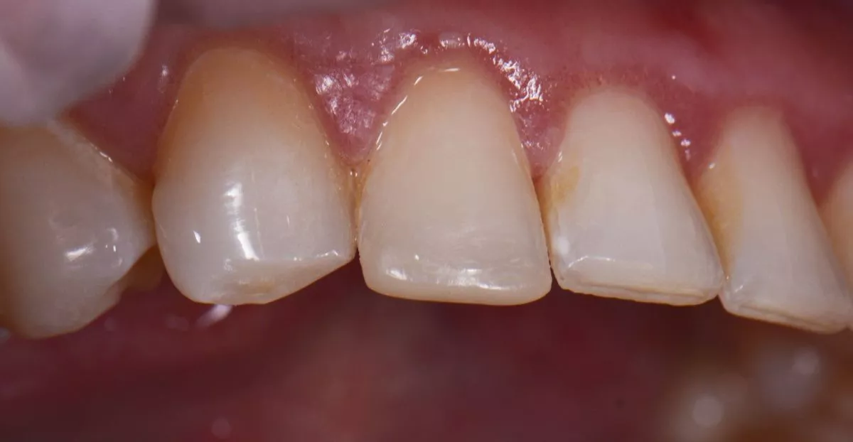 Стоматологии премиум класса в Москве. Реставрация сколов зуба