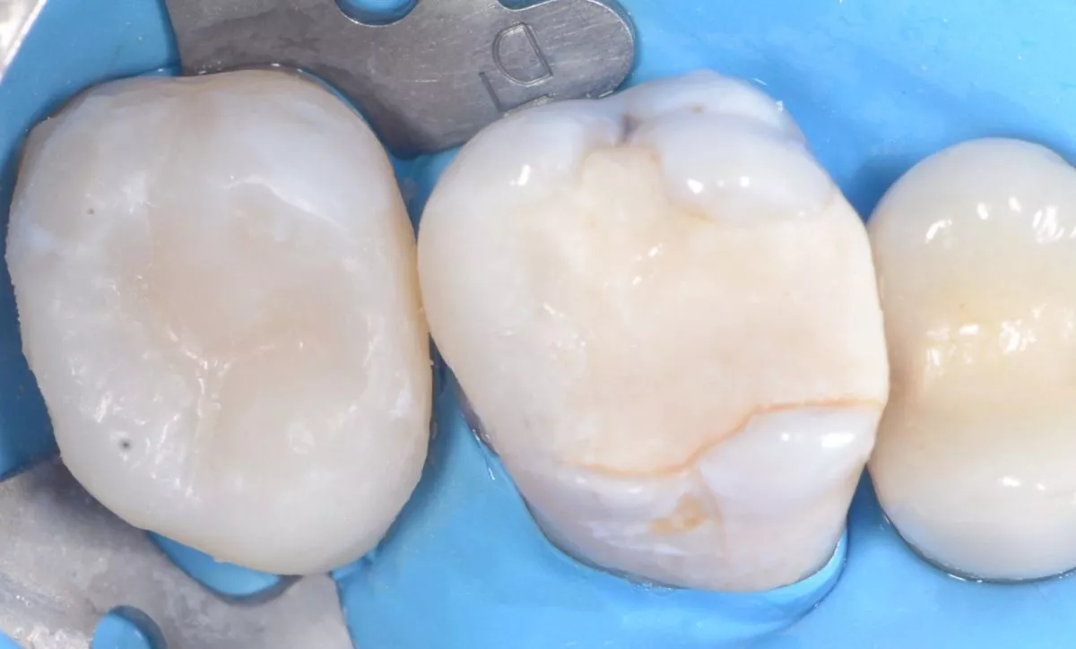 Где лучшая стоматология? Глубокий кариес жевательного зуба – сохранение зуба