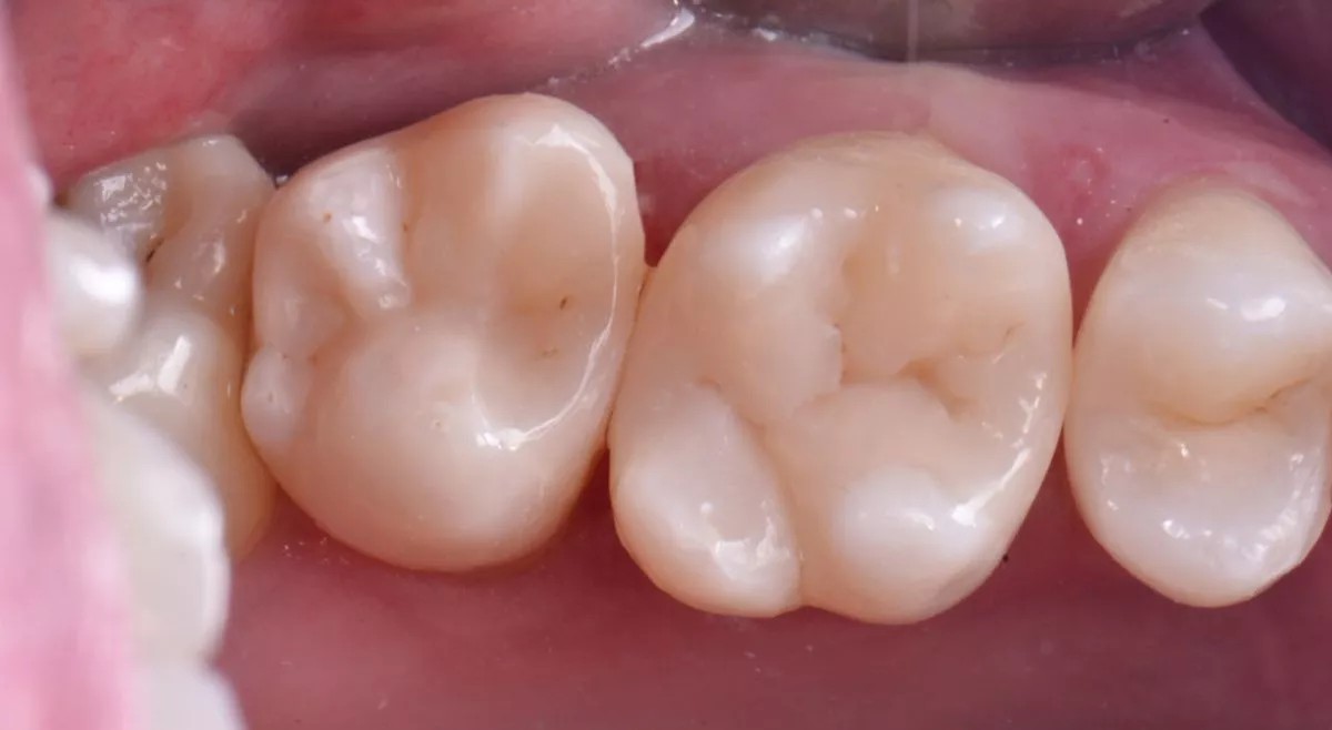 Стоматологии премиум класса в Москве. Контактный кариес под старой пломбой