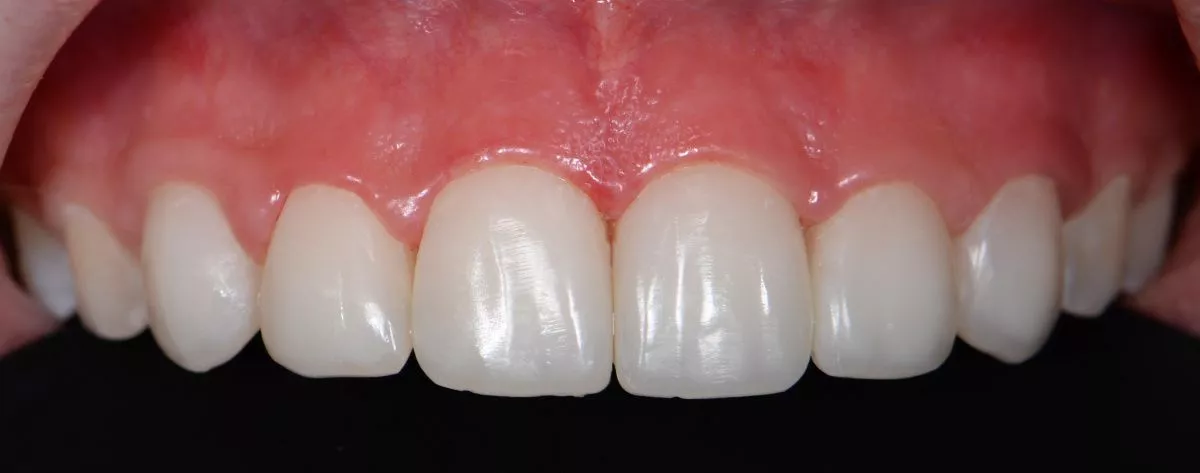 Лучшие стоматологические клиники. Композитные виниры в зоне улыбки