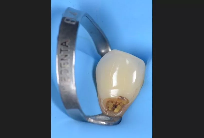 Стоматология Москва лучшие клиники. Лечение клиновидного дефекта - до процедуры