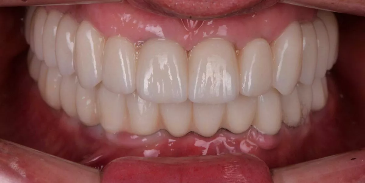 Премиум стоматологии Москва. Тотальная реабилитация - имплантация all-in-6 и замена керамических виниров и коронок