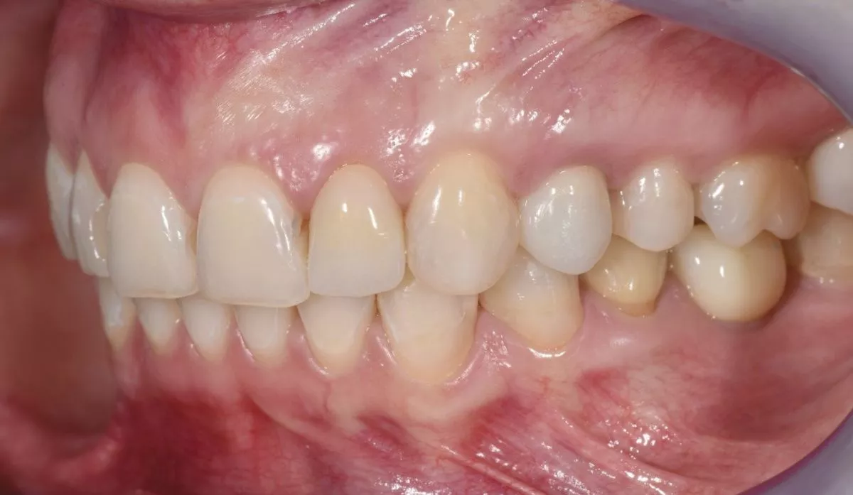 Где лучшая стоматология в Москве? Установка керамических виниров и коронок  - до процедуры