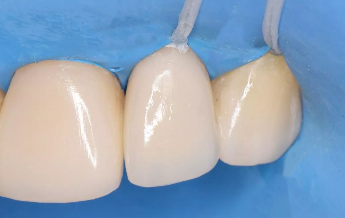 Стоматология Москва лучшие клиники. Эстетическая реставрация зуба в зоне улыбки