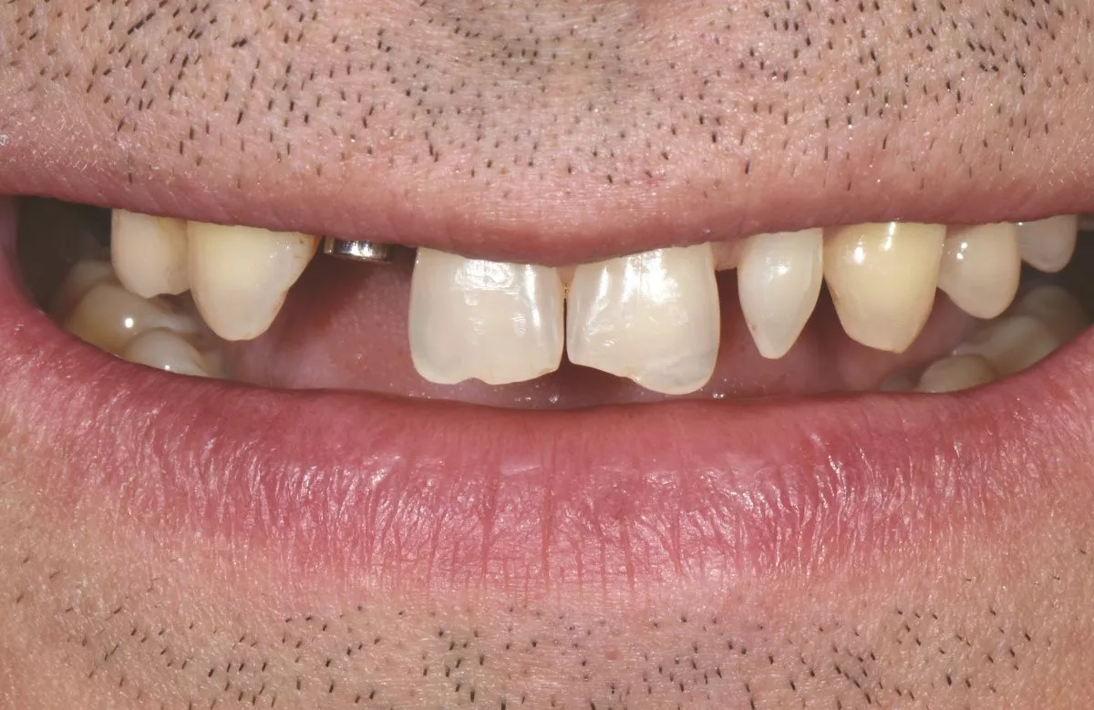 Где лучшая стоматология в Москве? Возвращение эстетики улыбки - установка керамических виниров и коронок - до процедуры