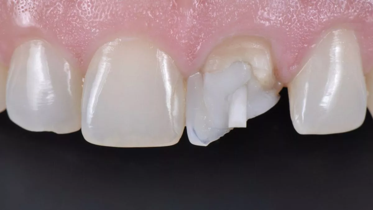 Стоматология Москва лучшие клиники. Прямая реставрация центрального резца со стекловолоконным штифтом - до процедуры