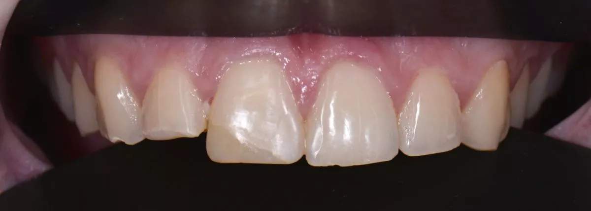 Стоматологии премиум класса в Москве. Художественная реставрация передних зубов - до процедуры