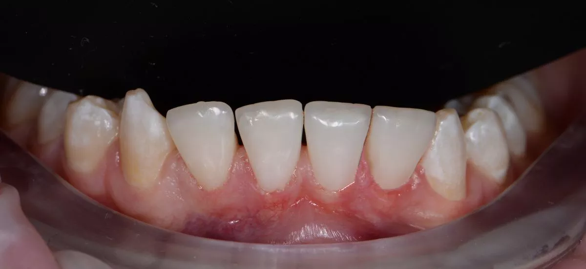 Лучшие стоматологические клиники. Восстановление эстетики нижних фронтальных зубов композитными винирами