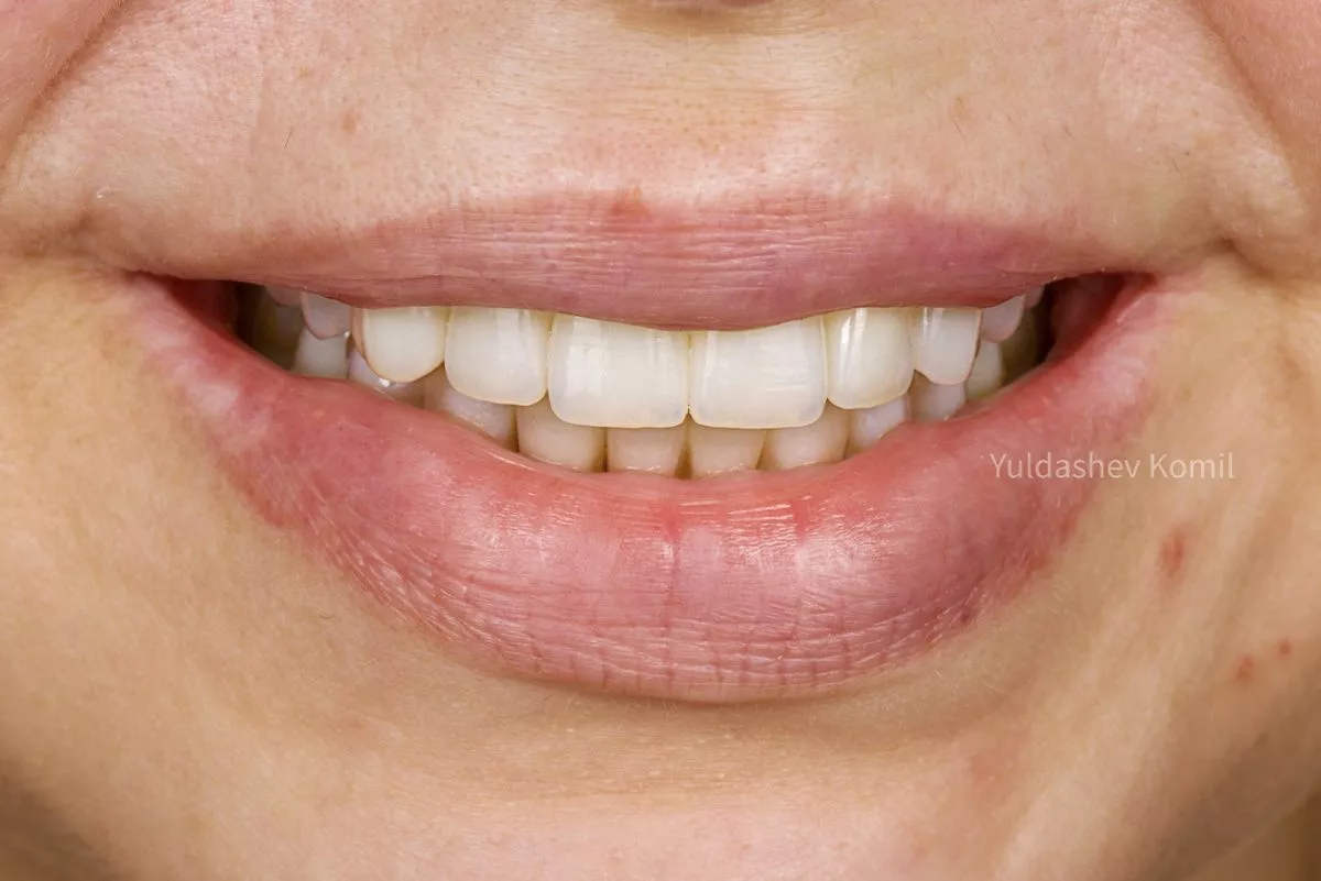 Фото после процедуры