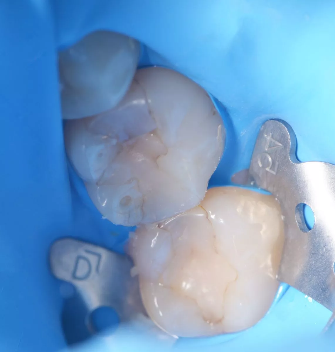 Где лучшая стоматология? Глубокий кариес жевательного зуба – сохранение зуба - до процедуры