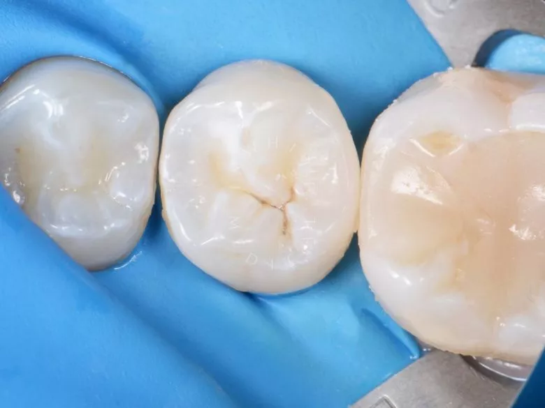 Лучшие стоматологические клиники Москвы. Лечение контактного кариеса - фото после процедуры