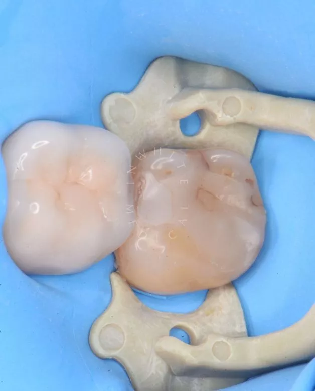 Где лучшая стоматология? Лечение фиссурного кариеса под увеличением - фото до процедуры