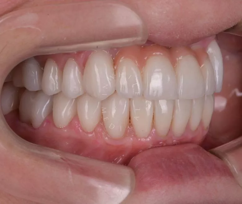 Лучшие клиники стоматологии. Замена старых коронок и установка виниров - фото после процедуры