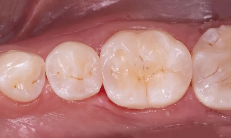 Фото после Лечение кариеса зубов в клинике Inwhite Medical