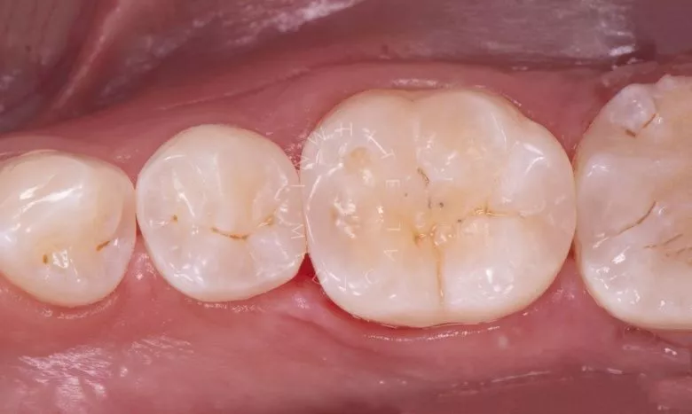 Элитная стоматология. Лечение кариеса зубов - фото после процедуры