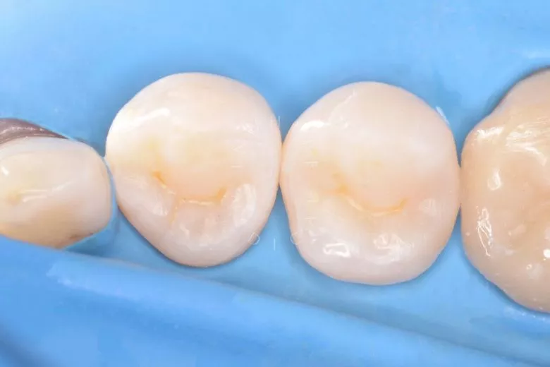 Лучшие стоматологические клиники Москвы. Лечение контактного кариеса - фото после процедуры