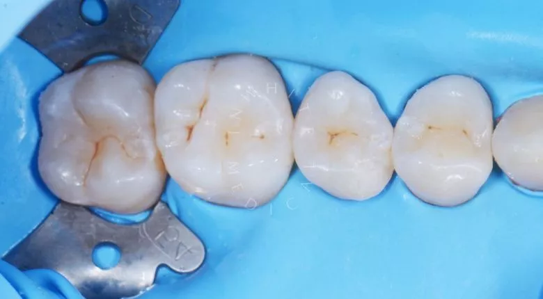Лучшие стоматологические клиники Москвы. Лечение кариеса 3-х зубов за один визит - фото после процедуры