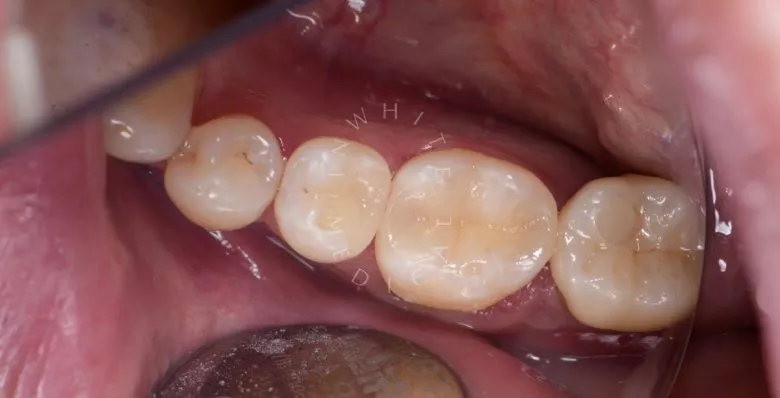 Лучшие стоматологические клиники Москвы.  Лечение скрытого кариеса под старой пломбой  - фото после процедуры