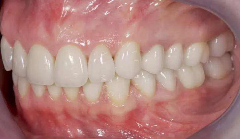 Фото после Установка керамических виниров и коронок  в клинике Inwhite Medical