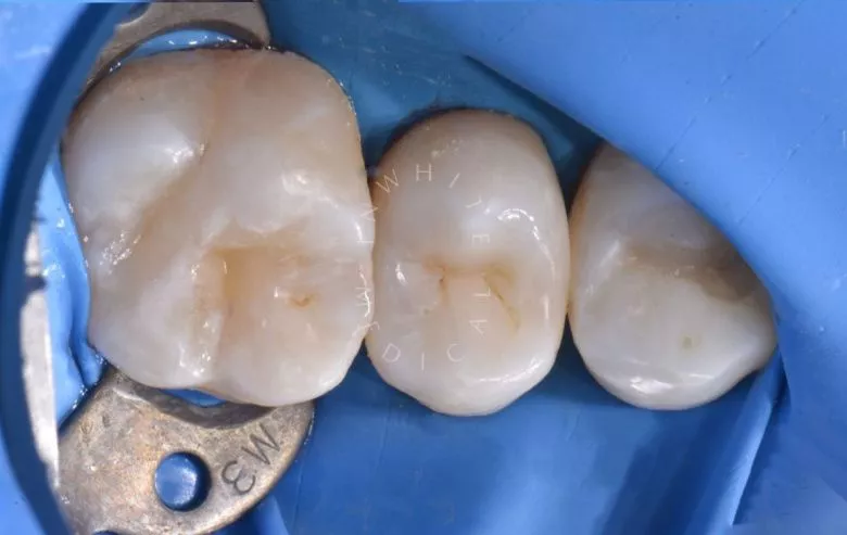 Фото после Глубокий кариес с риском пульпита – терапевтический подход в клинике Inwhite Medical