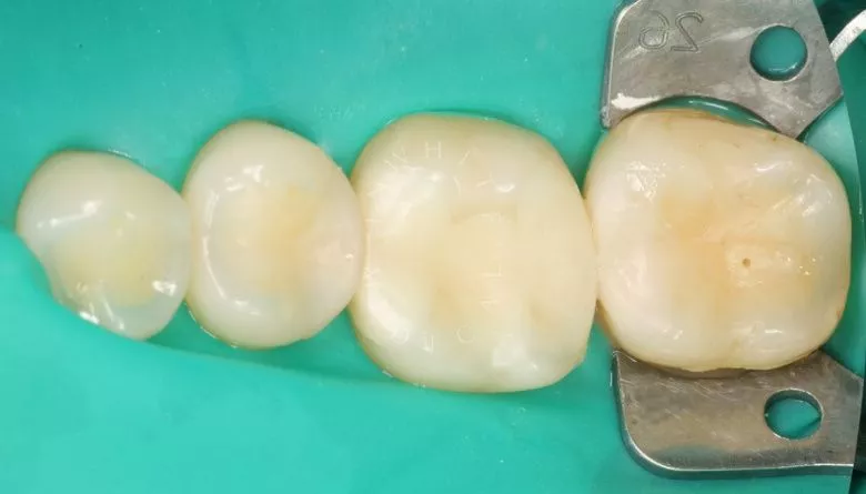 Где лучшая стоматология? Поверхностный кариес: лечение на ранней стадии - фото до процедуры