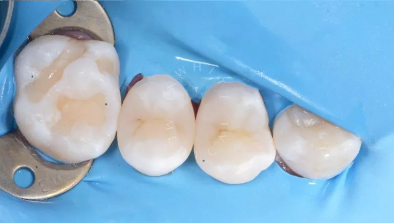 Фото после Контактный кариес с восстановлением контактного пункта в клинике Inwhite Medical