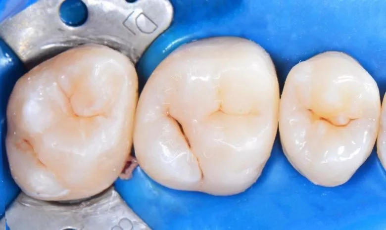 Лучшие стоматологические клиники Москвы. Лечение межзубного кариеса 3-х зубов - фото после процедуры