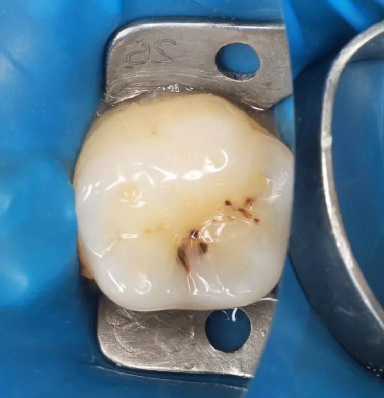 Где лучшая стоматология? Скрытый кариес: диагностика и лечение - фото до процедуры