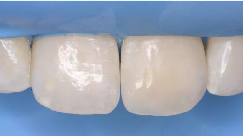 Где лучшая стоматология? Художественная реставрация переднего зуба с использованием композита. Восстановление оптики зуба - фото после процедуры