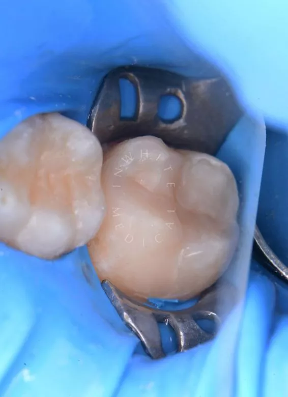 Где лучшая стоматология? Лечение скрытого кариеса на боковой поверхности зуба - фото после процедуры