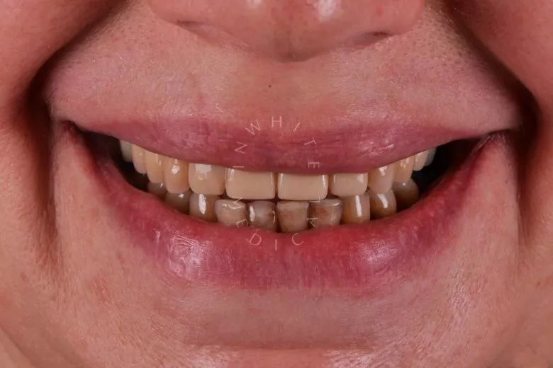 Лучшие клиники стоматологии. Восстановление эстетики зубов винирами и коронками - фото до процедуры