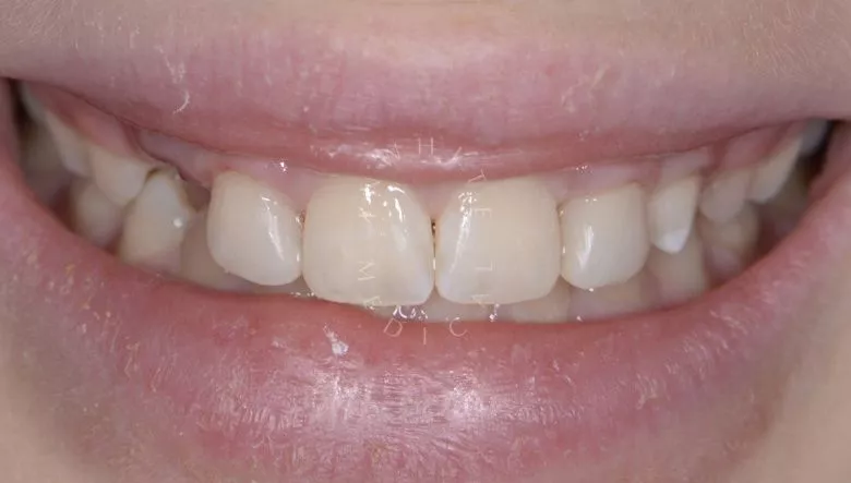 Где лучшая стоматология? Художественная реставрация переднего зуба - фото после процедуры