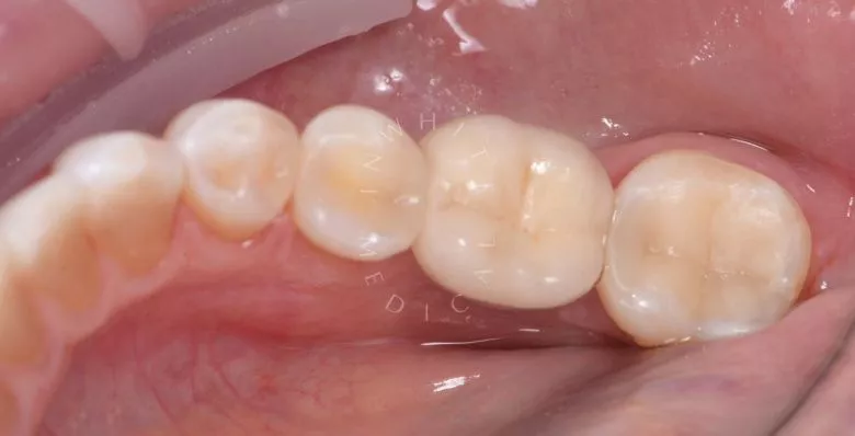 Лучшие стоматологические клиники Москвы.  Глубокий кариес жевательного зуба – сохранение функции и эстетики в рамках подготовки к протезированию - фото после процедуры