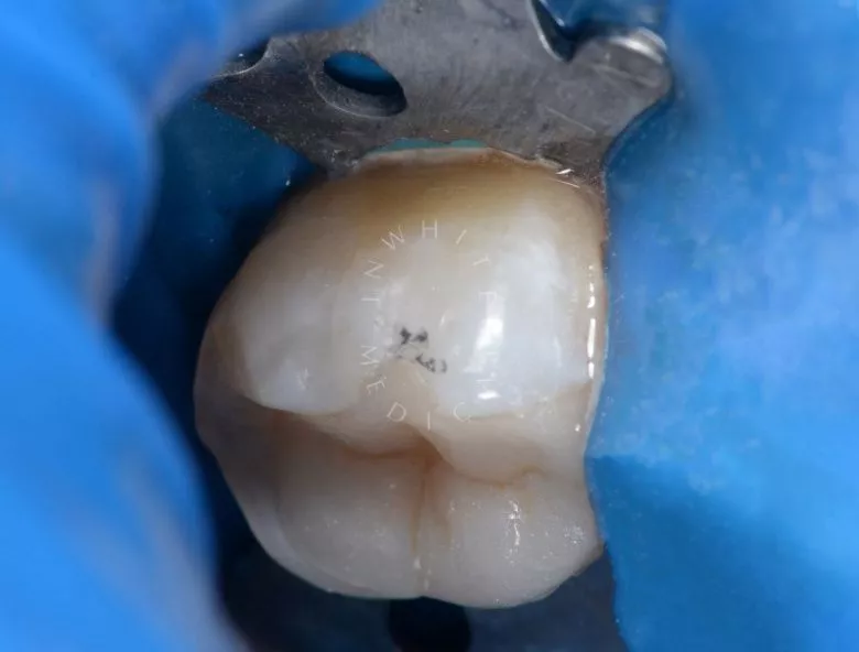 Лучшие стоматологические клиники Москвы. Пришеечный кариес с чувствительностью зуба - фото после процедуры