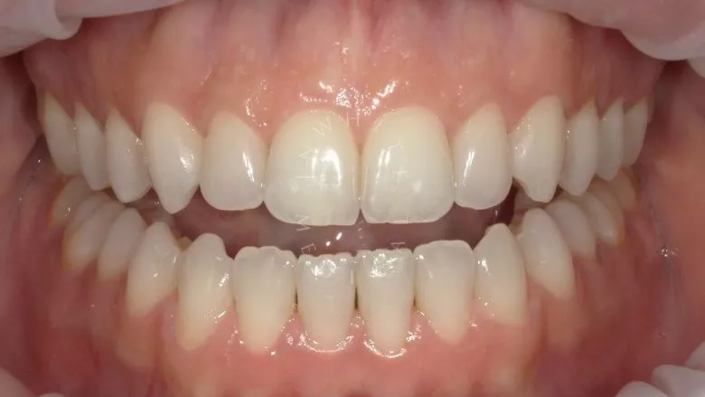 Фото до Отбеливание зубов - результат за одну процедуру в клинике Inwhite Medical